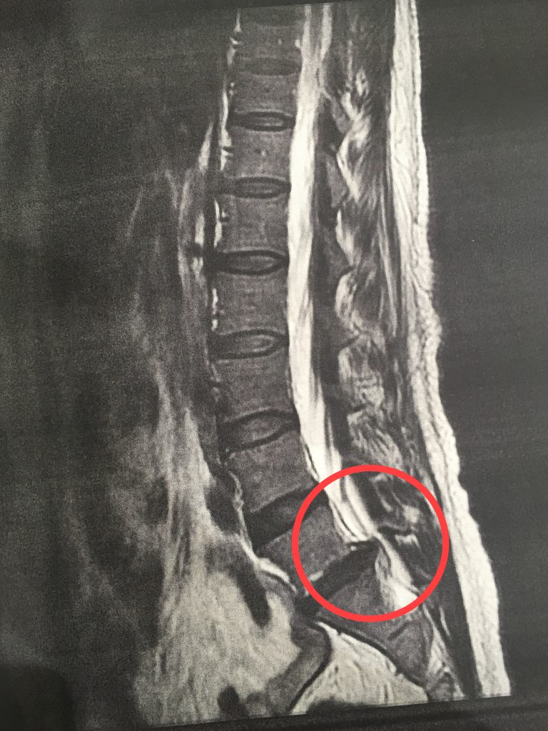 練習不足、外反母趾、足のアーチ少ない人がマラソンをすると○○○○になるかも！？