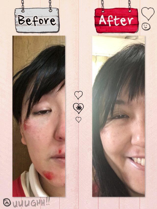 クレイビフォーアフター・傷へのケア